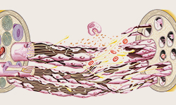 サブラクセーション